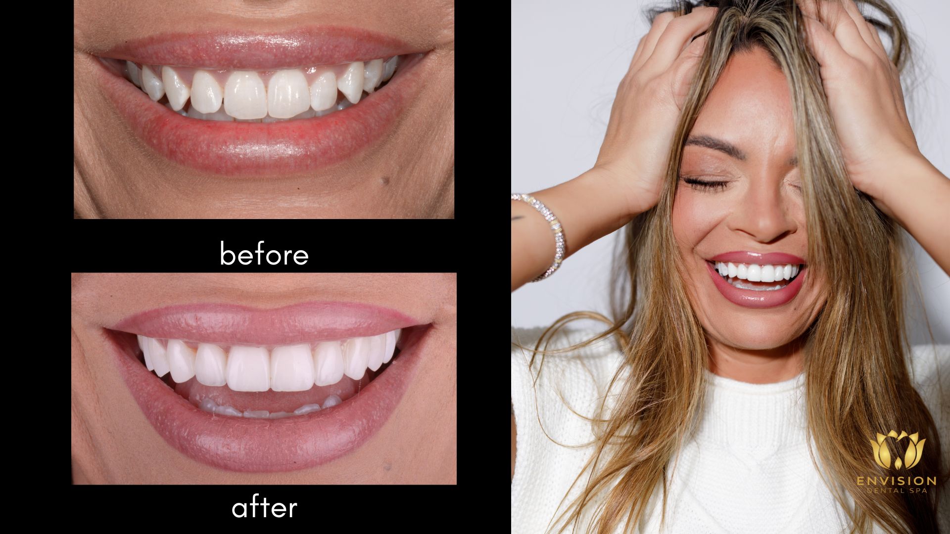 Kendra - Porcelain Veneers by Dr. Kabbani