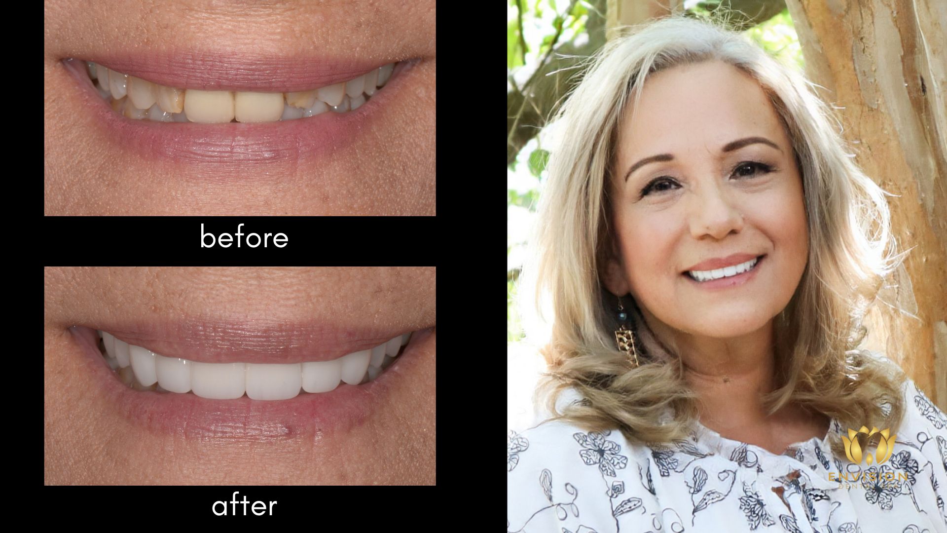 Irma - Porcelain Veneers by Dr. Kabbani